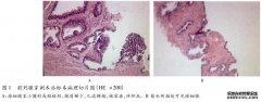 什么是腺泡前列腺癌？