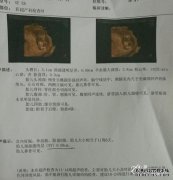 nt怀孕的价值是什么？