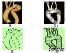 先天性右椎动脉发育不良