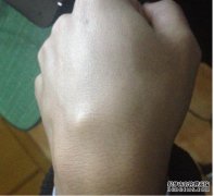 头部后面有一块骨头肿块。