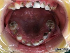 一个半岁大的婴儿跌落在牙齿上，从嘴里流血。