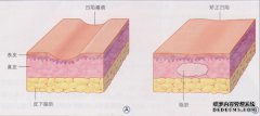如何填充凹痕