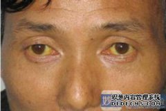 全身黄色，身体发痒。