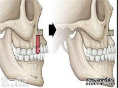 什么是牙槽骨吸收？